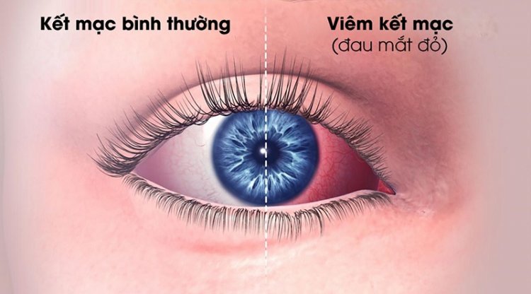 Cách trị đau mắt đỏ tham khảo &#038; lời khuyên, Sài Gòn List