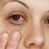 Cách trị đau mắt đỏ tham khảo & lời khuyên