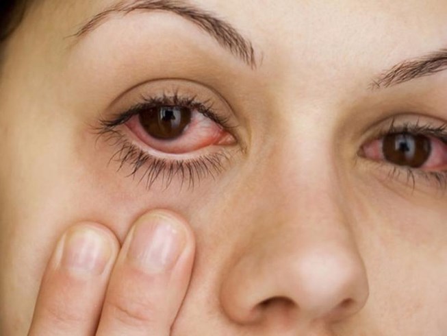 Cách trị đau mắt đỏ tham khảo & lời khuyên