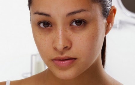 causes of dark circles